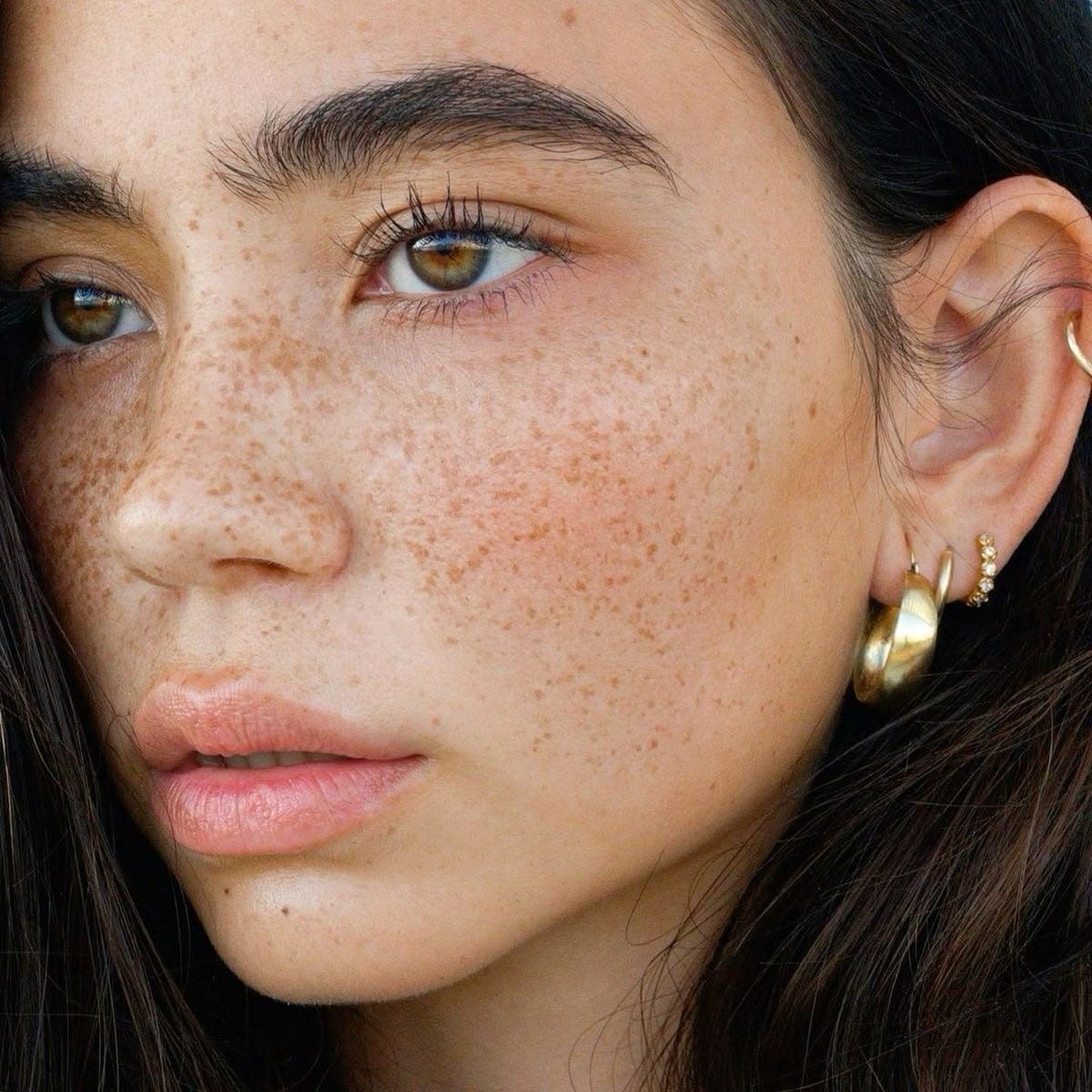 Freckles
